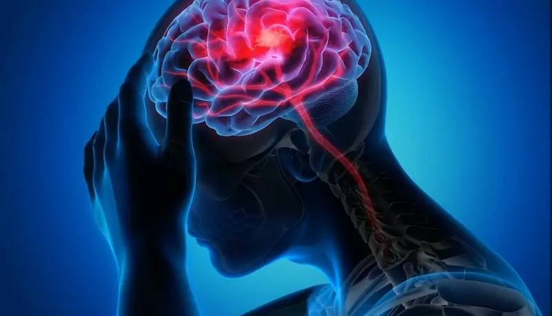 سکته مغزی 10 سال زودتر در کمین ایرانیان