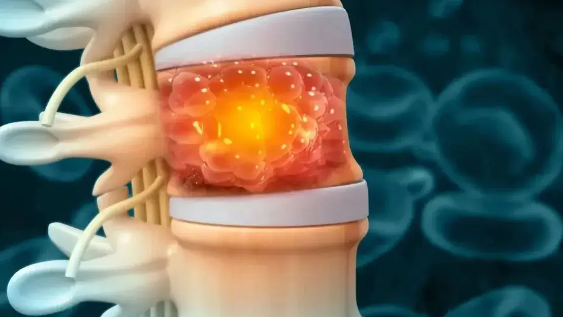 علامت شایع سرطان استخوان که خیلیها جدی نمیگیرند