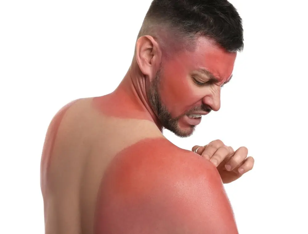 تنها یک آفتابسوختگی شدید میتواند سلامت ما را برای همیشه تغییر دهد