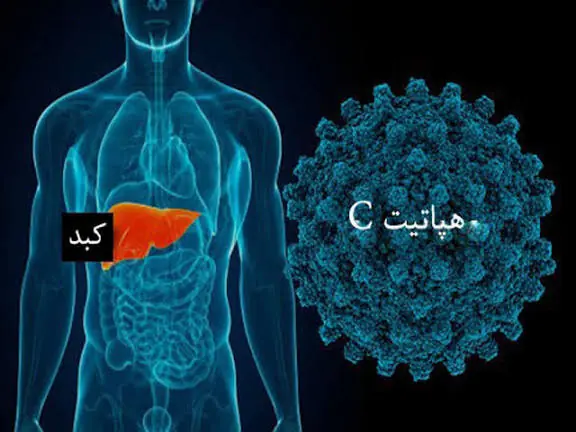 هپاتیت C بیماری خاموش بدون واکسن اما قابل درمان