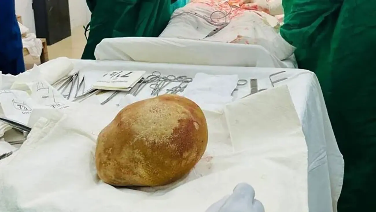 خارج شدن بزرگ ترین سنگ مثانه جهان از بدن بیمار 55 ساله