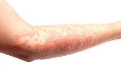 راهکارهایی برای تشخیص کهیر و چیزهایی که باعث آن میشود | آخرین خبر