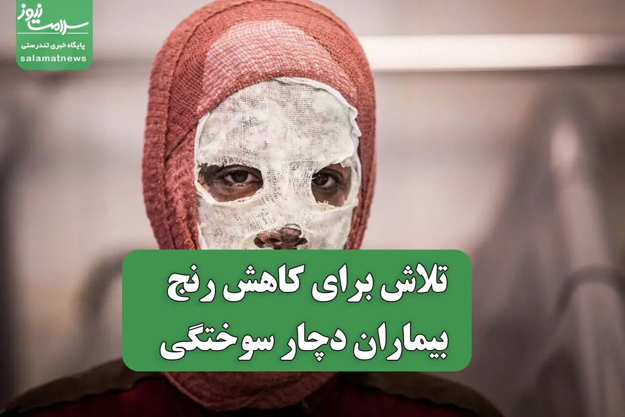 تلاش برای کاهش رنج بیماران دچار سوختگی