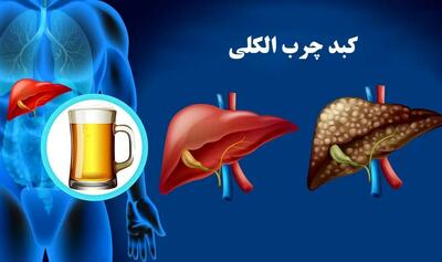 الکل دوز امن ندارد؛ آسیبهای کبدی ممکن است تا مراحل پیشرفته خاموش بمانند
