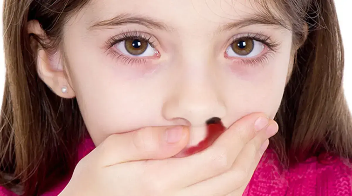  هشدار اورژانس ۱۱۵ مشهد پیرامون عارضه شایع «خونریزی بینی»