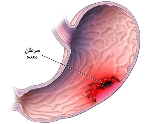  فاکتورهای مؤثر در سرطان معده! | آخرین خبر