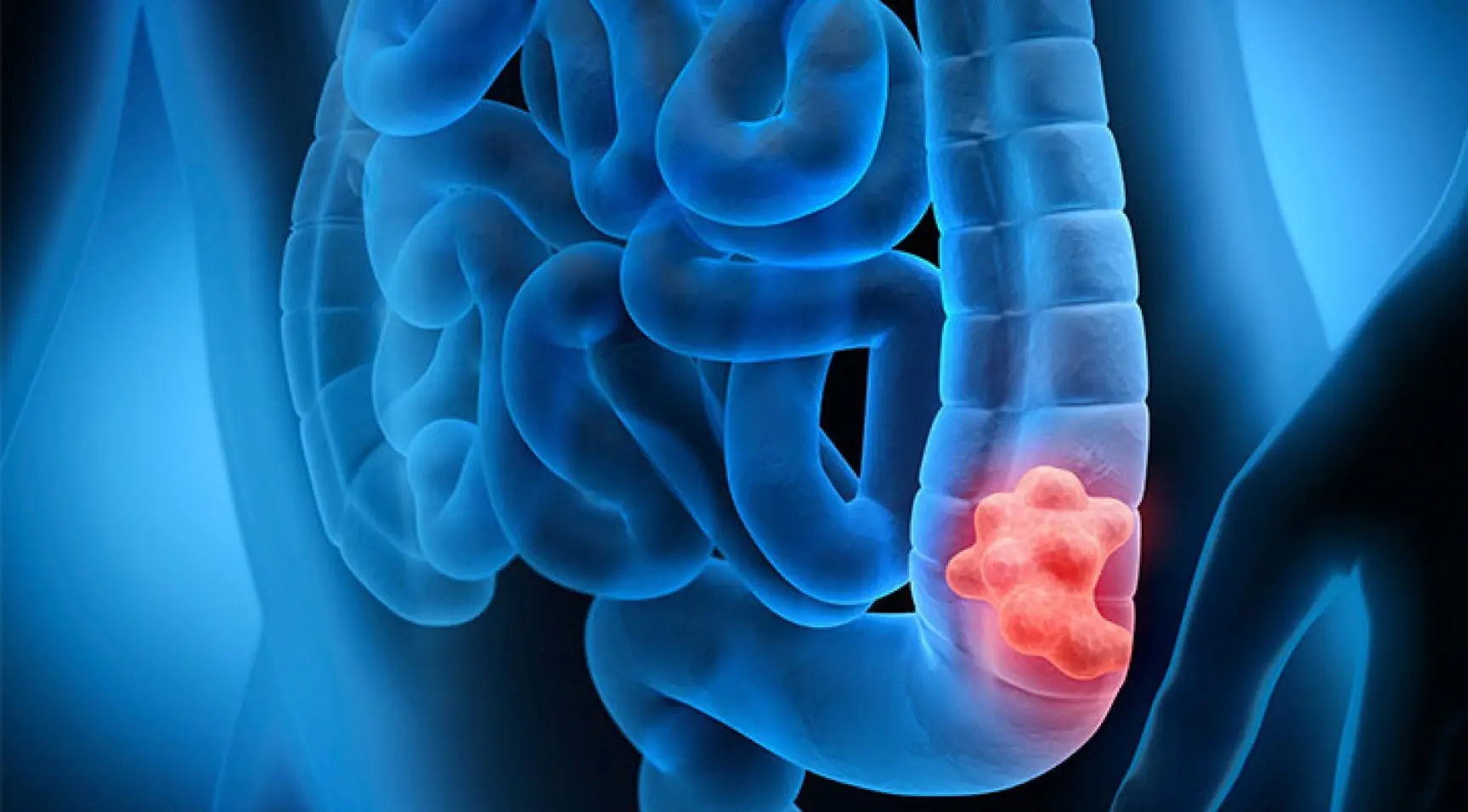 باکتریهای دهان ممکن است سرطان روده را آشکار کنند