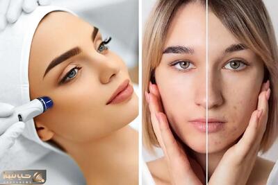 میکرودرم واقعا صورت رو جوان میکنه یا نه؟ عوارض، مراقبت ها و پوست هایی که لازمشونه