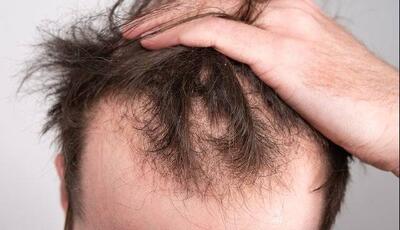 ماینوکسیدیل خوراکی برای ریزش موی مردانه موثرتر است | آخرین خبر