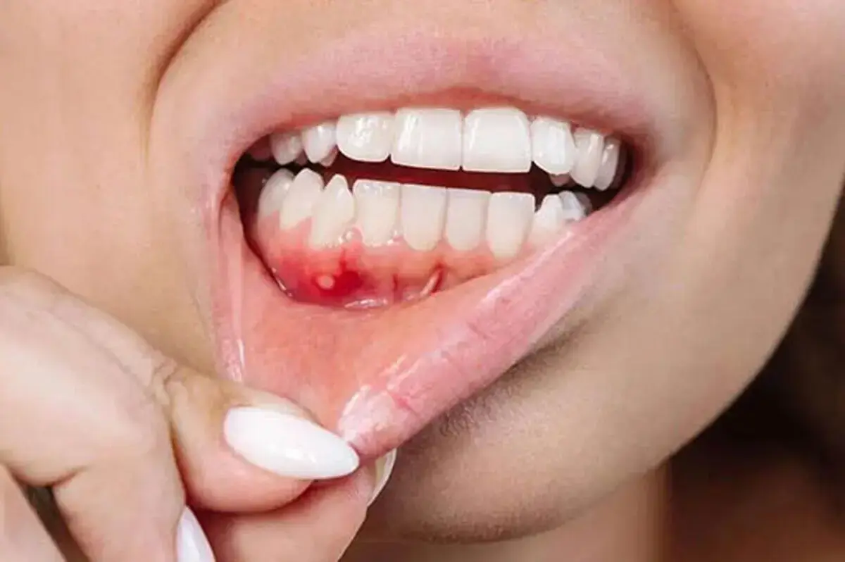 جایگزین طبیعی آنتیبیوتیک برای درمان بیماری لثه