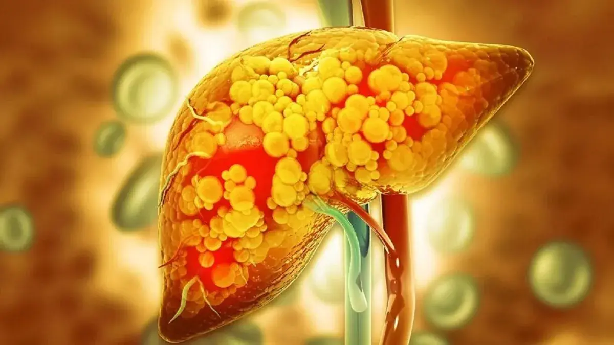  این رژیم غذایی، داروی اصلی مقابله با کبد چرب است