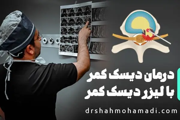 چگونگی درمان دیسک کمر با لیزر دیسک کمر PLDD و توصیههای جراح متخصص