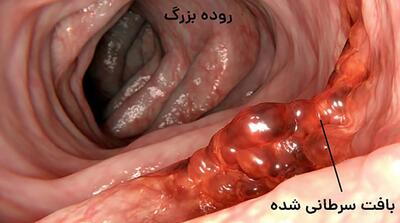  سرطان شایع در ایران که هیچ علامتی ندارد!