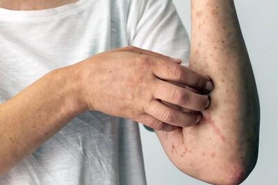 بیماری لوپوس چیست و چگونه در بدن ایجاد میشود؟