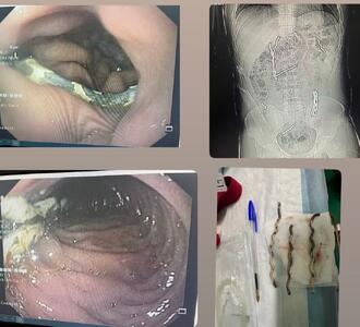 خروج سه قطعه فنس از دستگاه گوارش جوان ساوجی
