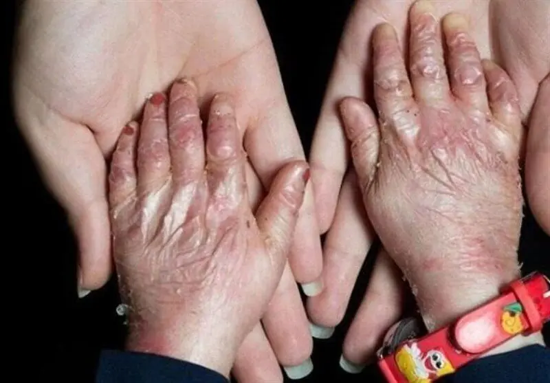بیماران پروانهای تحت پوشش خدمات رایگان دندانپزشکی قرار میگیرند