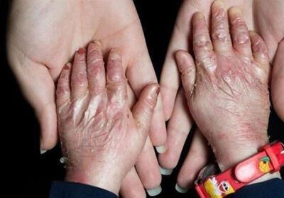  بیماران پروانه‌ای تحت پوشش خدمات رایگان دندانپزشکی قرار می‌گیرند - تسنیم