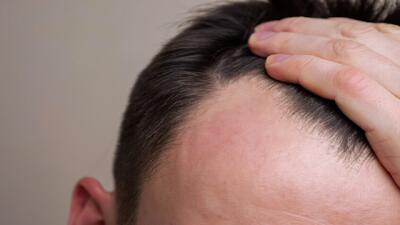 ارتباط برخی از داروهای کاهش وزن با ریزش مو