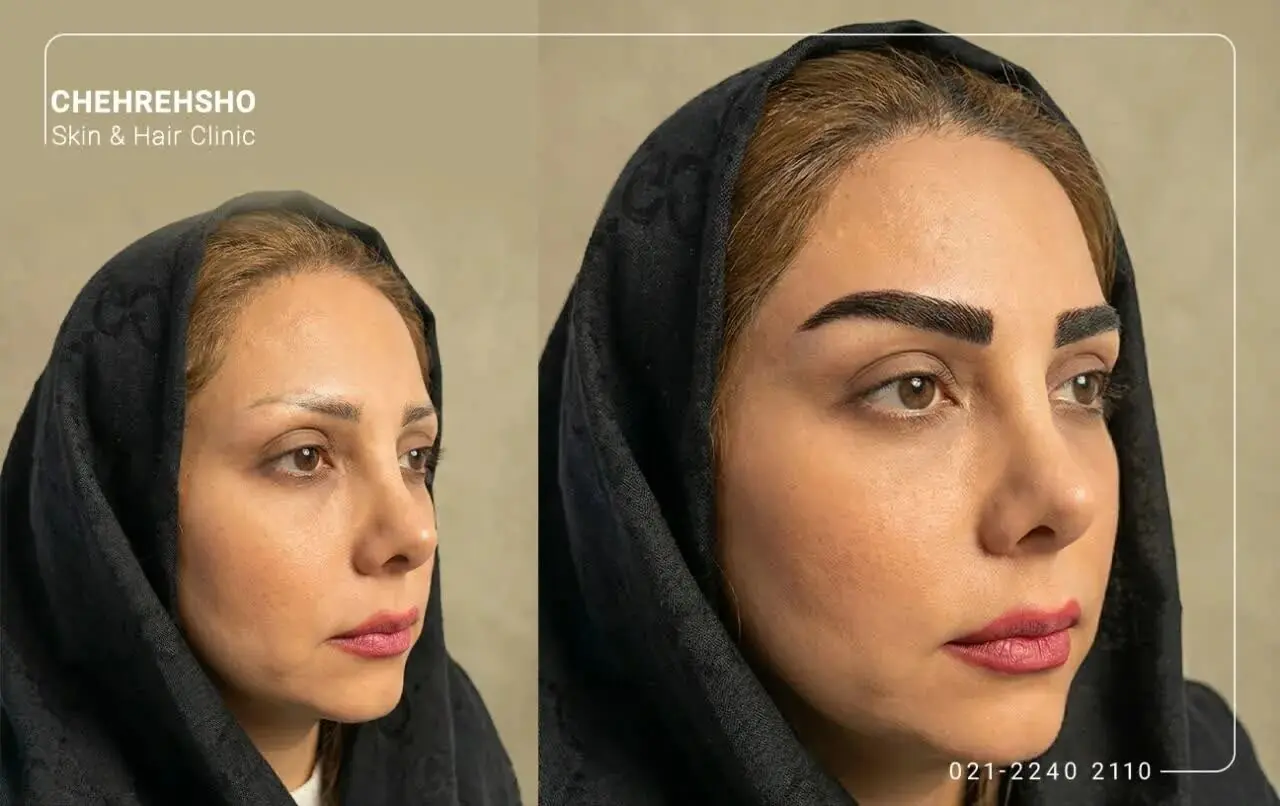 بهترین سن برای کاشت ابرو؛ آیا در یائسگی و سنین بالا امکانپذیر است؟