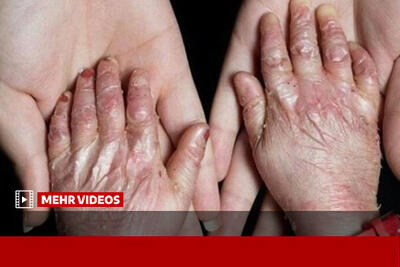  خسارت بیماران پروانه‌ای از اموال توقیف‌شده آمریکا پرداخت شد