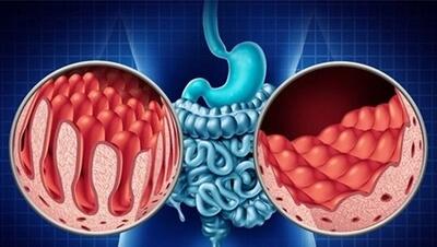  از سلیاک؛ بیماری هزارچهره‌ چه می‌دانید؟