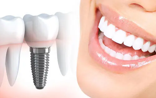 راههای بازسازی لبخند پس از از دست دادن دندان: از ایمپلنت تا طراحی لبخند