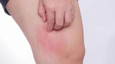  منشا سرطان های پوست  | آخرین خبر