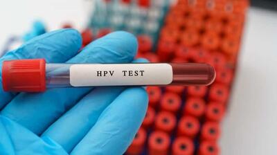  سن اچ‌پی‌وی به ۱۵ سال رسید | زنده ماندن ویروس زیر ناخن تا ۱۴ روز | اگر آزمایش HPV مثبت شد چه کنیم؟