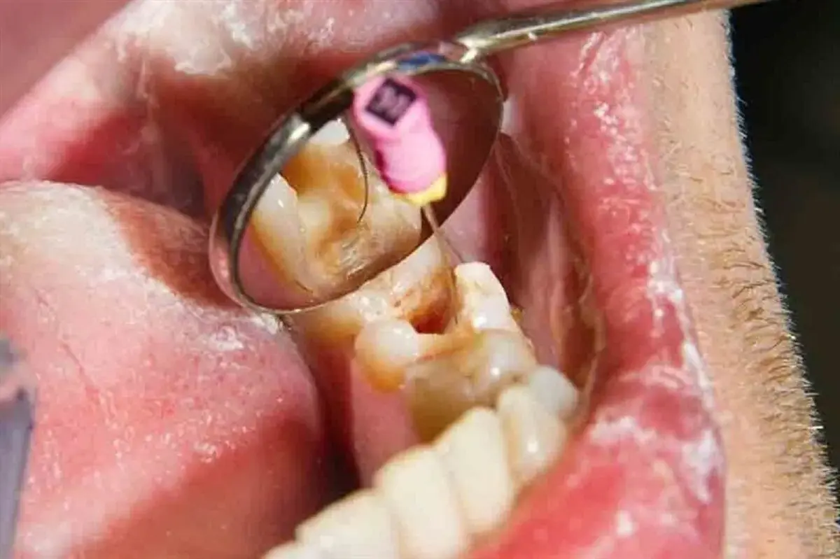 عصبکشی با تعرفه دولتی آغاز شد؛ دندانهایتان را ارزانتر درمان کنید