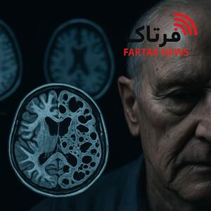  بیماری کروتزفلد–یاکوب؛ بیماری نادری که می‌تواند حافظه و توانایی حرکت را به‌سرعت مختل کند