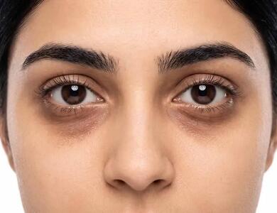  علت تیرگی و پف زیر چشم چیست؟