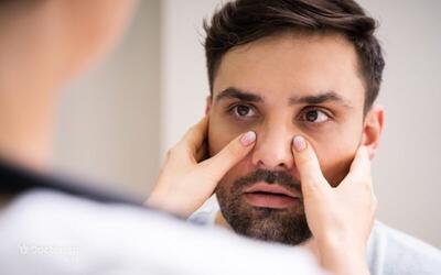  واقعا کمبود آهن را می‌توان از روی چهره تشخیص داد؟ نشانه‌هایی که باید جدی بگیرید