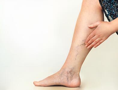  واریس پا چیست؟؛ جلوگیری از گسترش واریس پا با این راهکارهای ساده