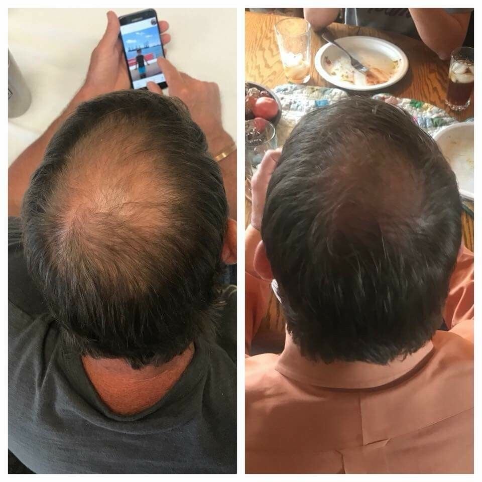 افشای رازی که به درمان ریزش مو ایرانیها کمک کرد!