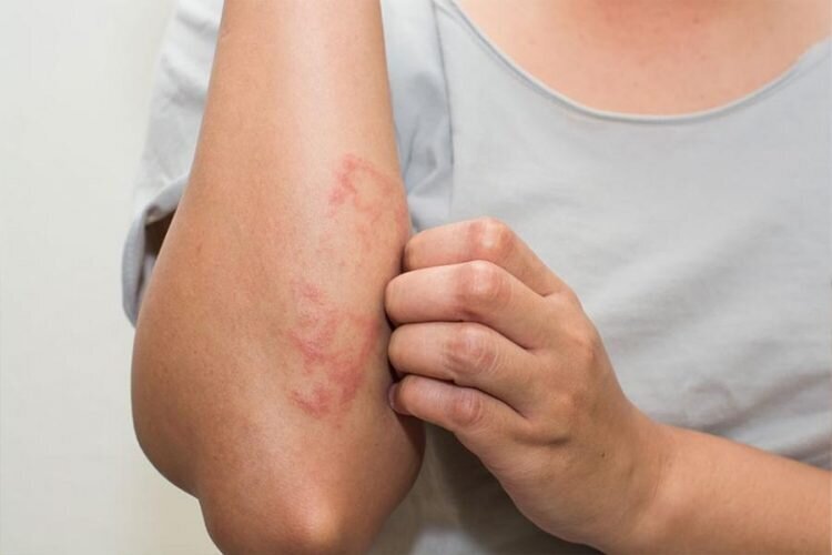 کمک به بیماران پسوریازیس با  «زالو درمانی»؛ معجزه ای دیگر از طب سنتی