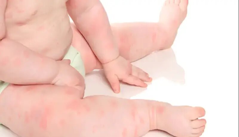 پوست کودک حرف میزند