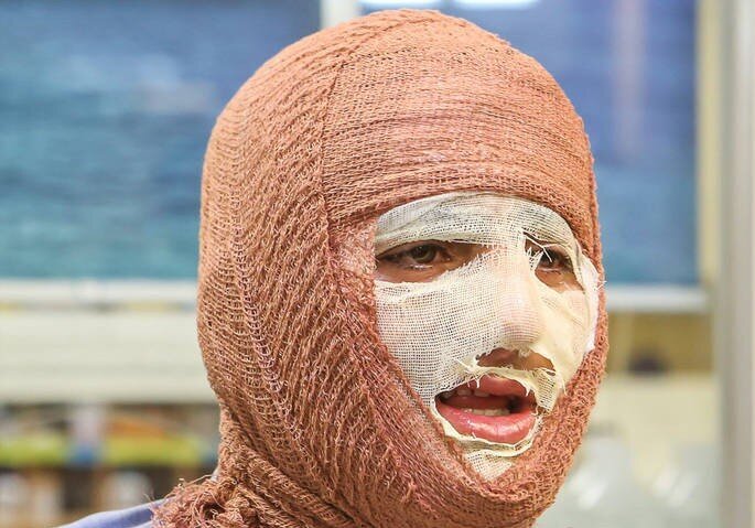 جلالی: سالانه حدود ۳۰۰ هزار نفر به مراکز سوختگی کشور مراجعه میکنند