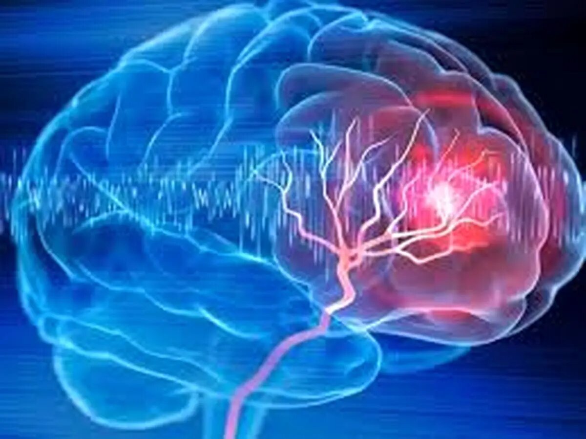 تغییر نرخ ارز درمان نوپای سکته مغزی  دچار مشکل کرده است