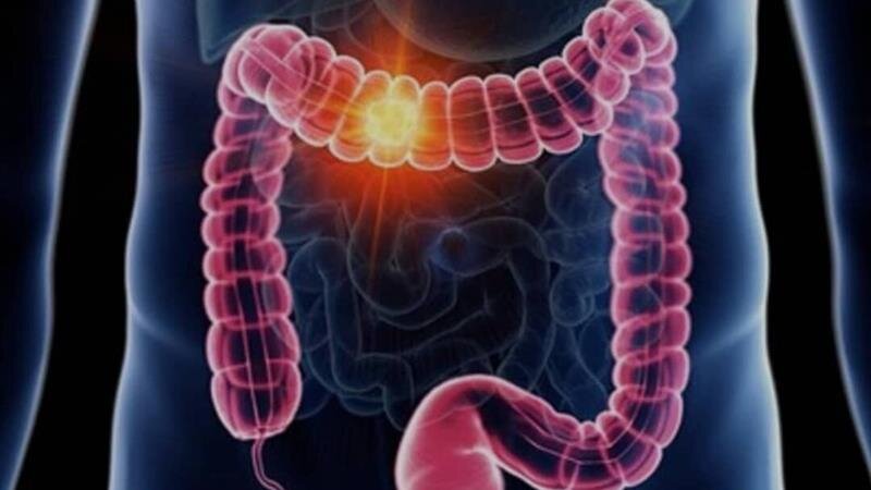 علائم گوارشی را ساده نگیرید؛ هر خونریزی هموروئید نیست