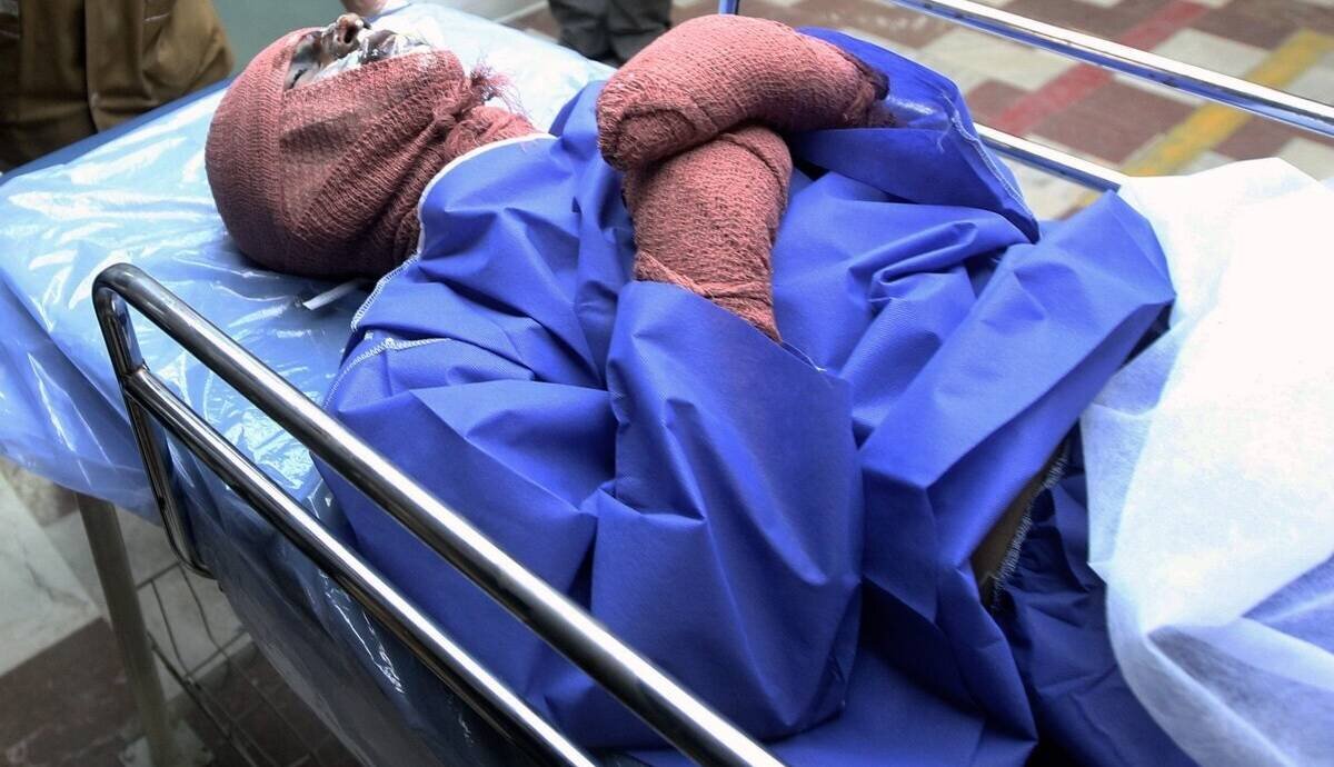 آمار عجیب سوختگی در ایران ؛ ۳۰۰ هزار نفر در سال!