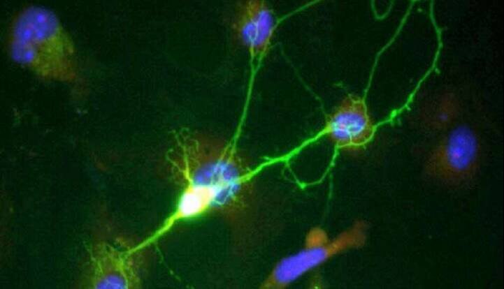 جلوگیری از مرگ نورون‌ها در آلزایمر با یک داروی رایج