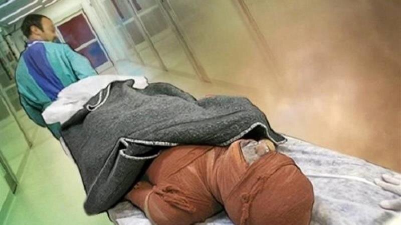 سوختگی در ایران؛ آماری فراتر از حادثه / سالی ۳۰۰۰۰۰ سوختگی و زنگ خطر ایمنی در کشور