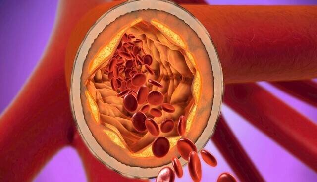 کلسترول تنها پیشبینیکننده بیماری قلبی نیست