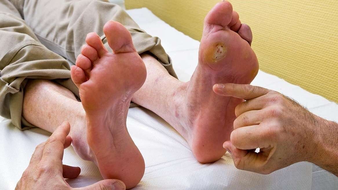 هشدار به دیابتی ها؛ بی دردی زخم نشانه آسیب عصبی است!
