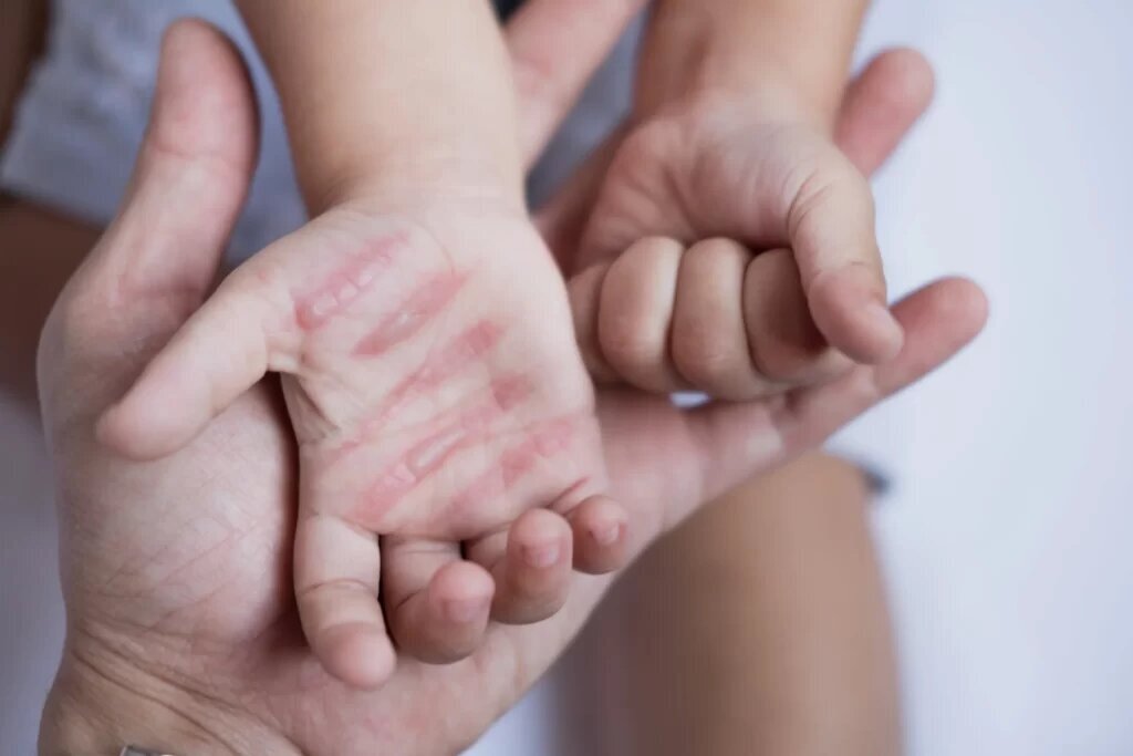 از کمبود تخت تا هزینه‌های سنگین درمان؛ روایت سوختگی در ایران