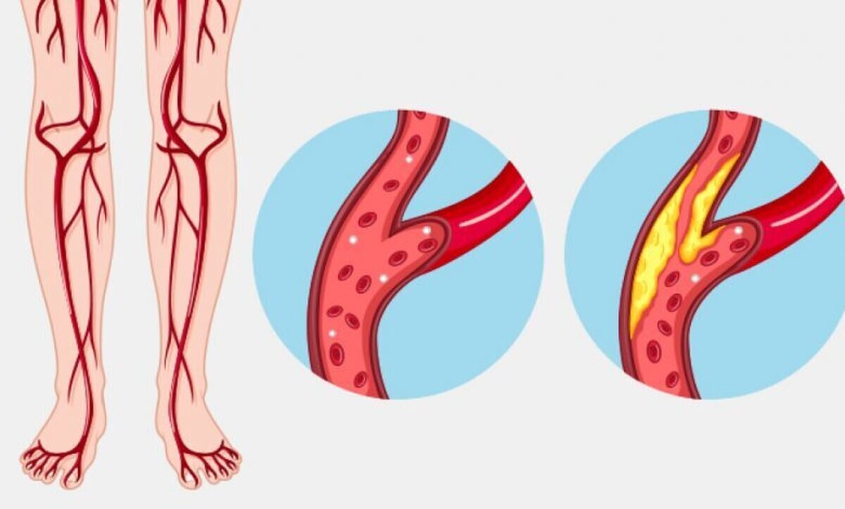 عوامل خطر بیماری‌های عروقی را بشناسیم