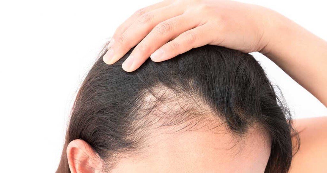 آیا سطح بالای سختی آب واقعا باعث ریزش مو می شود؟