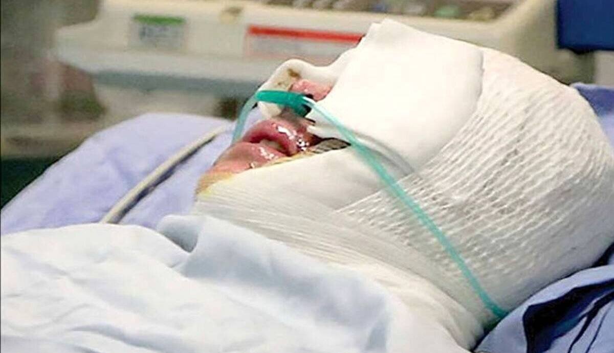 اسیدپاشی هولناک بر روی دختر ۲۰ ساله