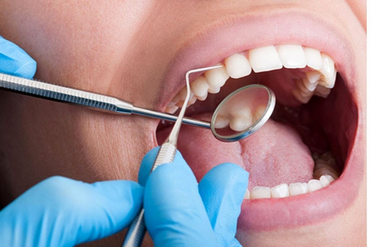 پوسیدگی‌های دندانی تا حد زیادی قابل پیشگیری هستند/ درمان زیبایی بدون بهداشت، ماندگار نیست