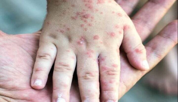 ثبت ۷۱۴ مورد «سرخک» در کشور؛ اوج ابتلا در اردیبهشت